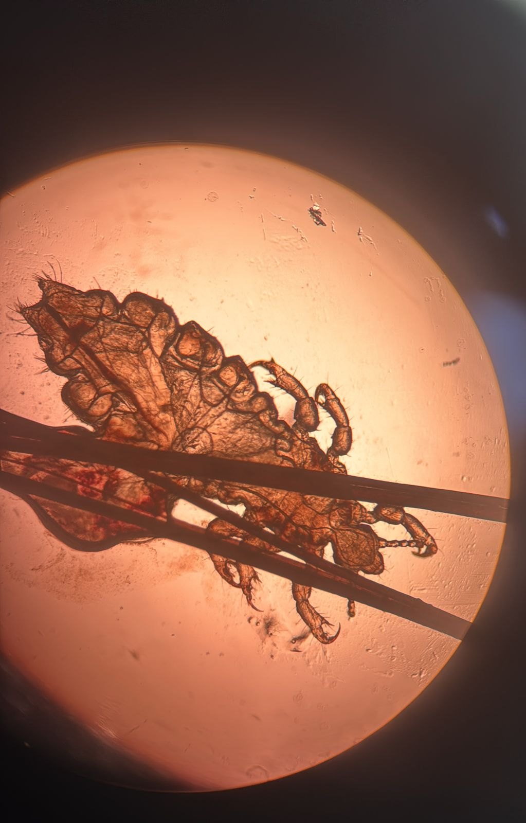 Clinical case of Pediculosis