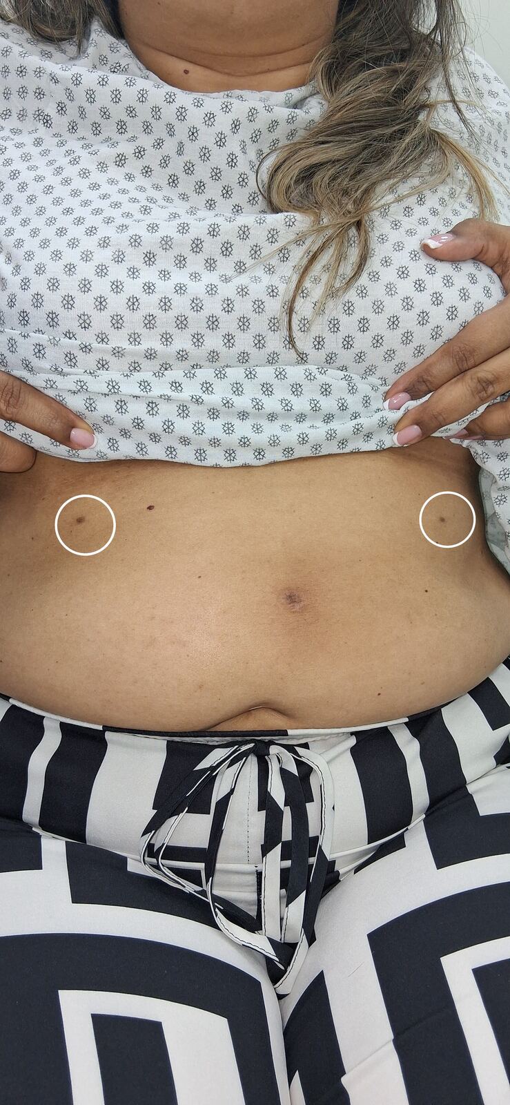 Clinical case: Accessory nipple