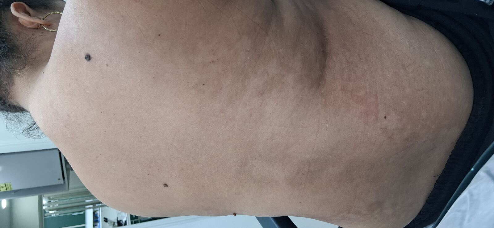 Pityriasis alba: before image