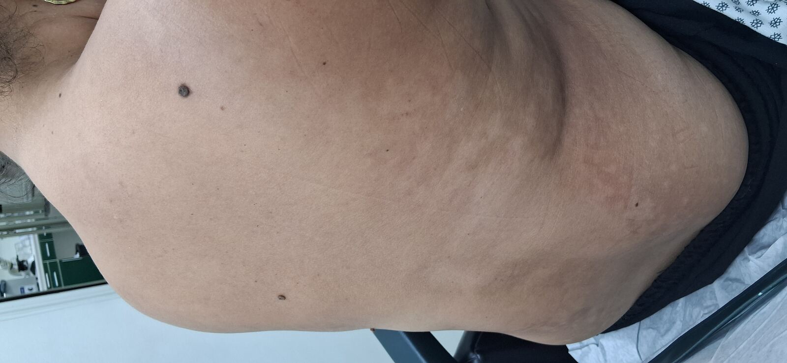 Pityriasis alba: after image