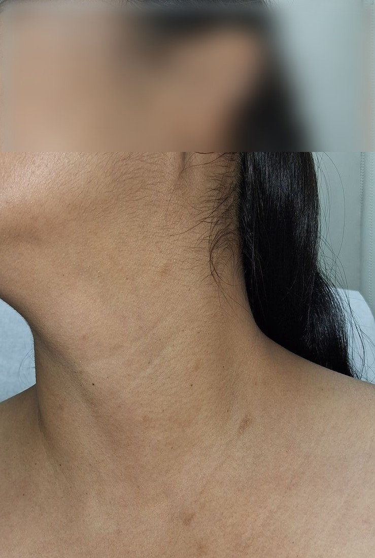 Pityriasis rosea: before image