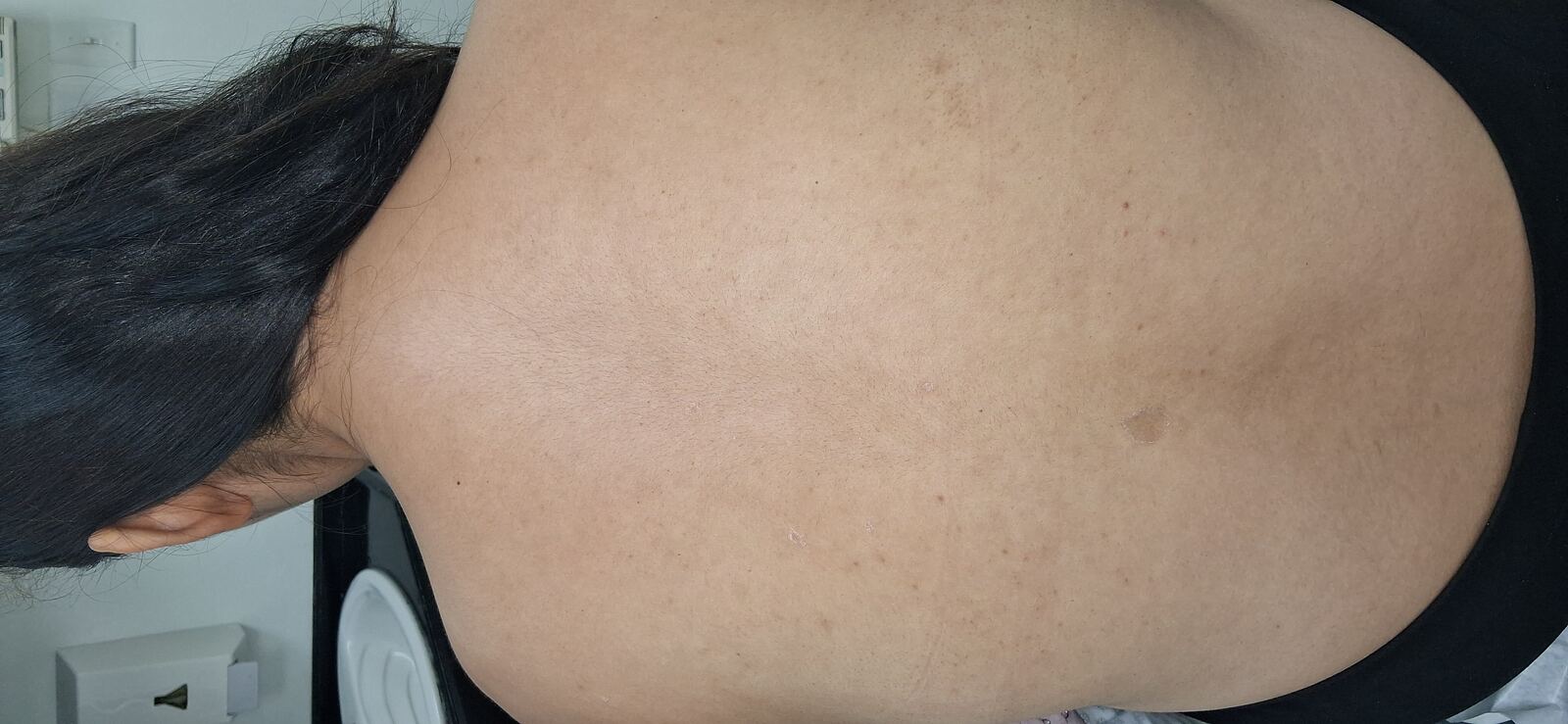Pityriasis rosea: after image
