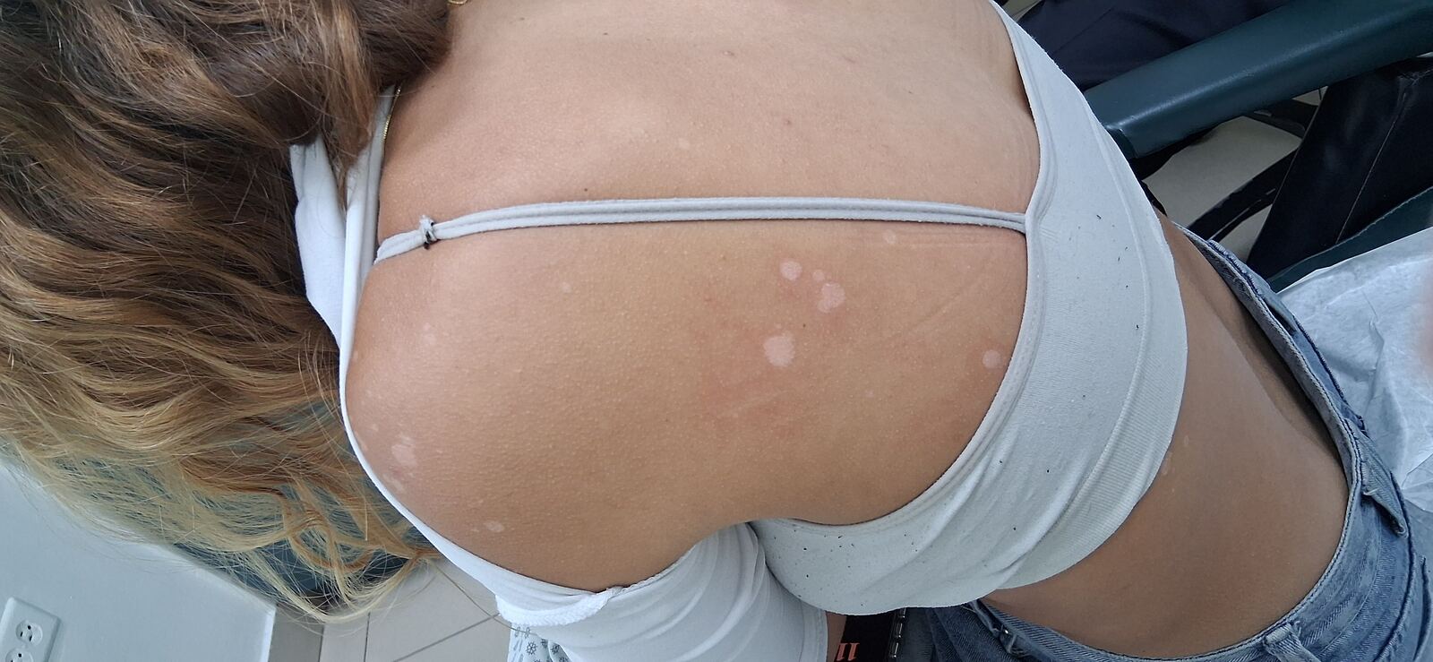 Pityriasis versicolor and guttate hypomelanosis: before image
