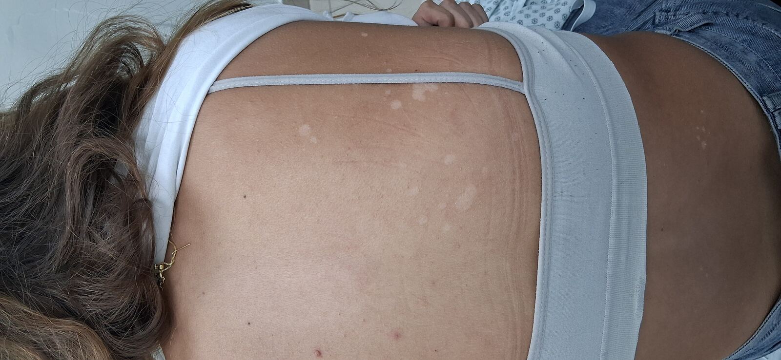 Pityriasis versicolor and guttate hypomelanosis: after image