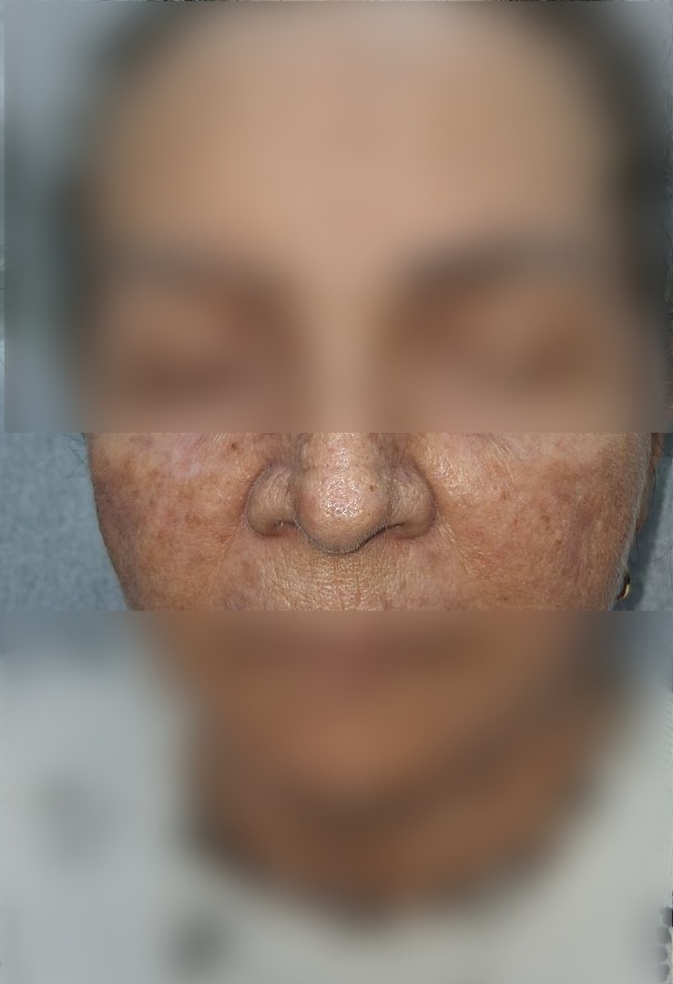 Platelet-rich plasma: before image