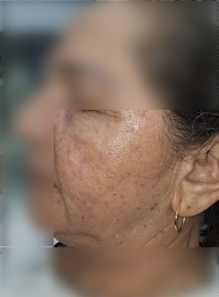 Platelet-rich plasma: after image
