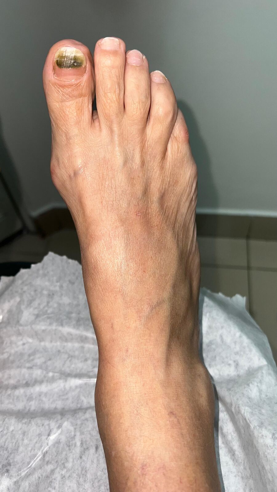 Subungual Pseudomonas: before image