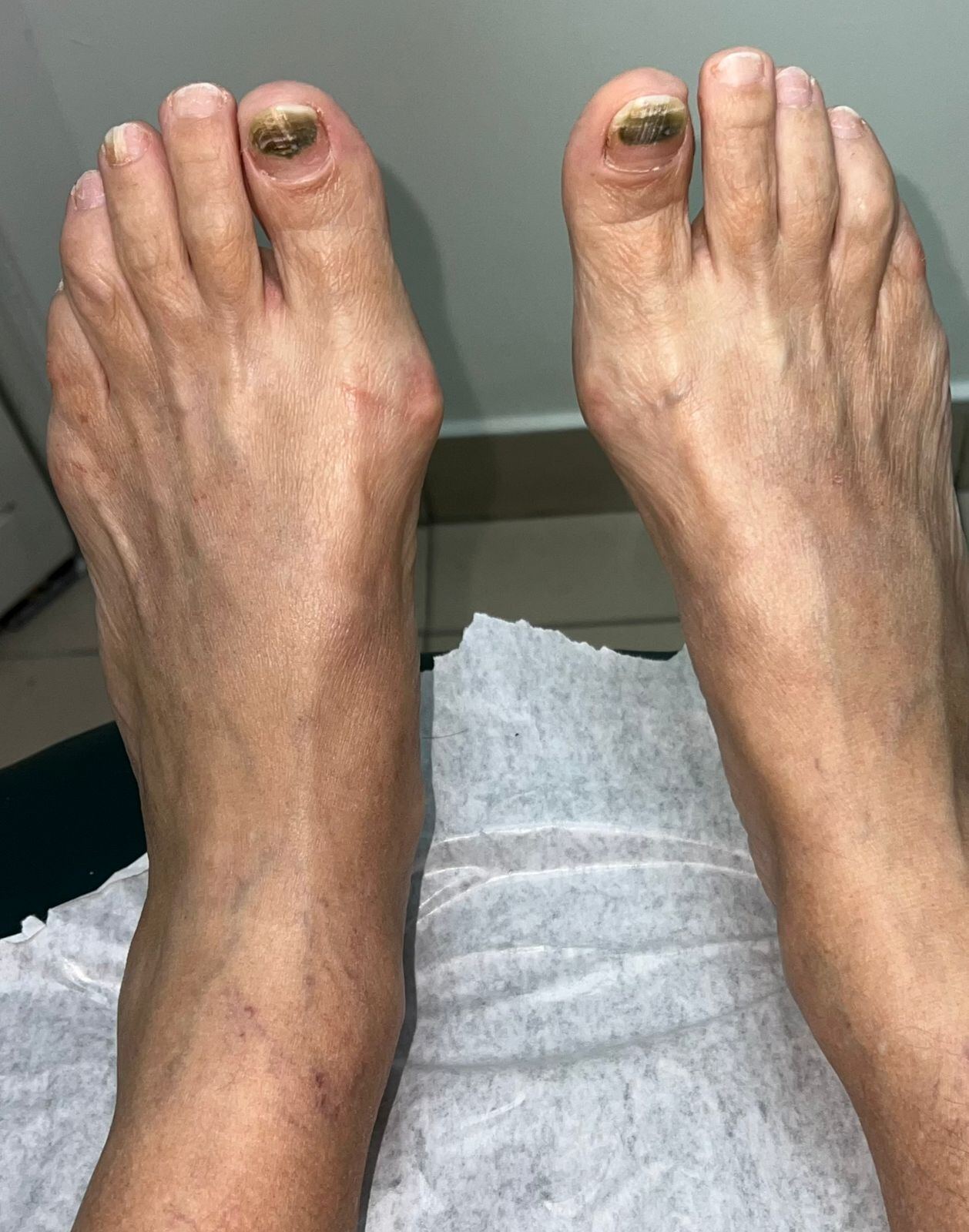 Subungual Pseudomonas: after image
