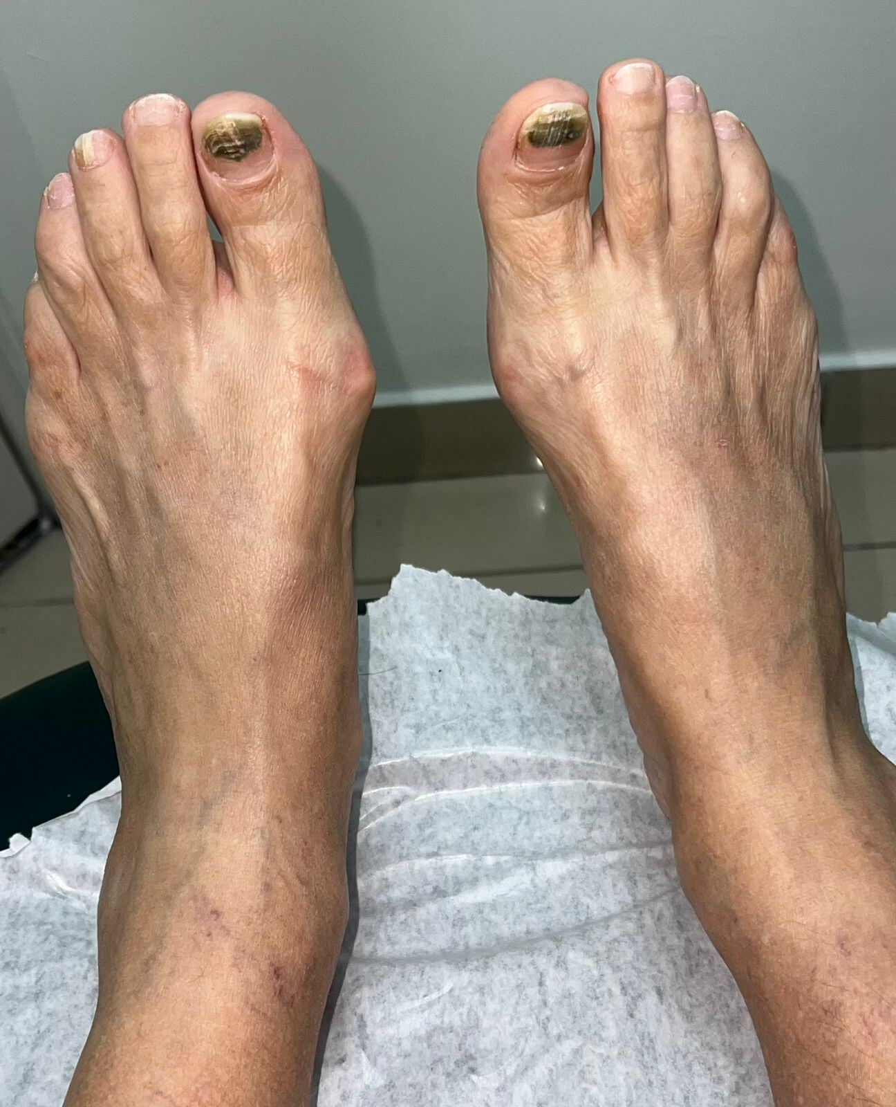 Clinical case: Subungual Pseudomonas
