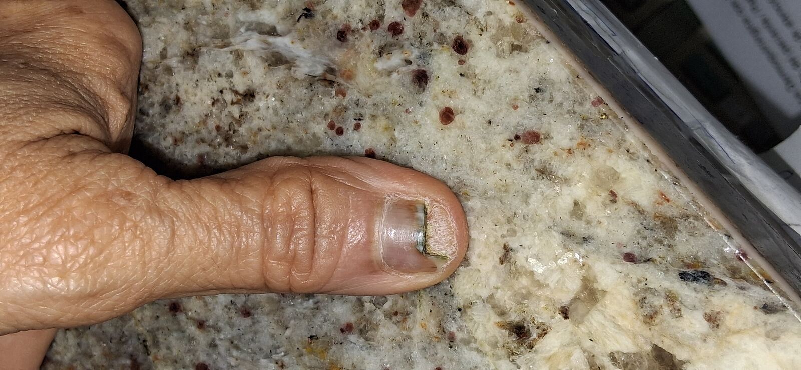 Clinical case: Pseudomonas