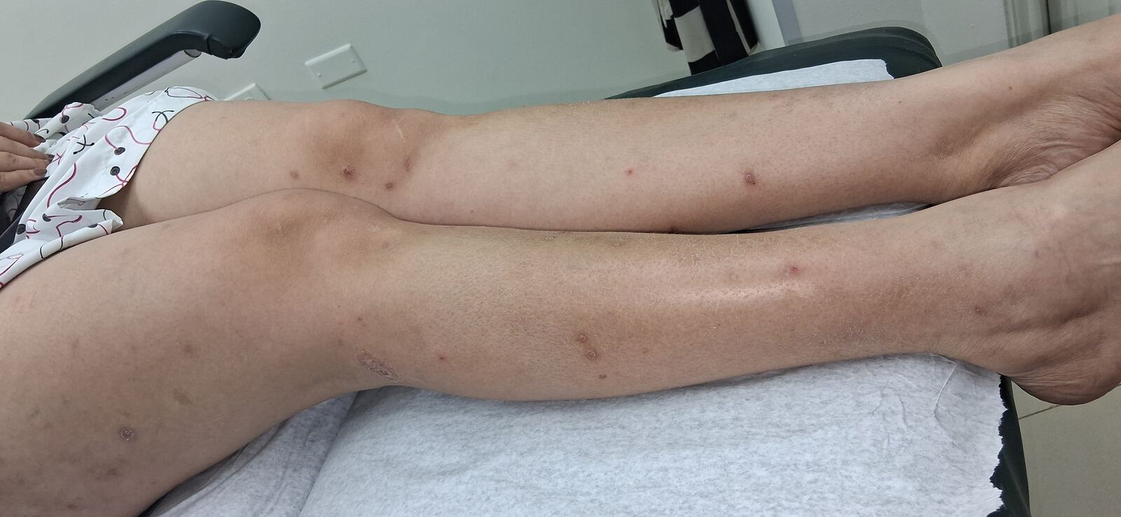 Guttate psoriasis: before image
