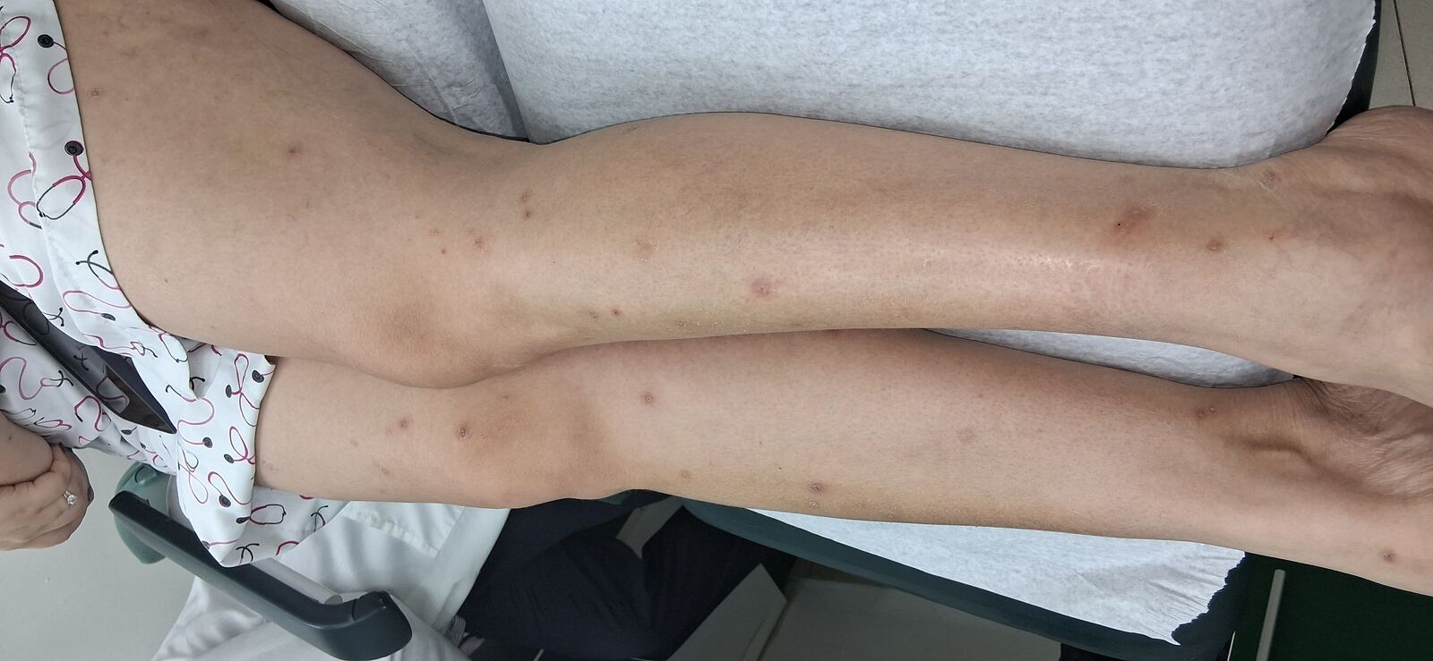 Guttate psoriasis: after image