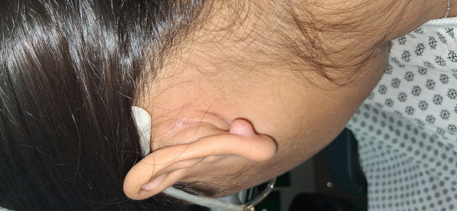 Keloid: before image
