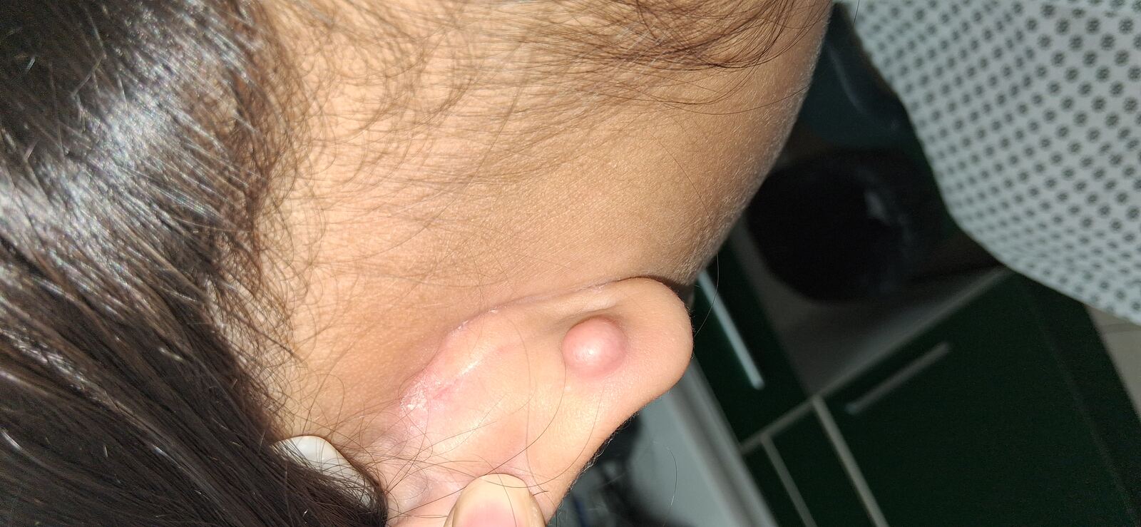 Keloid: after image