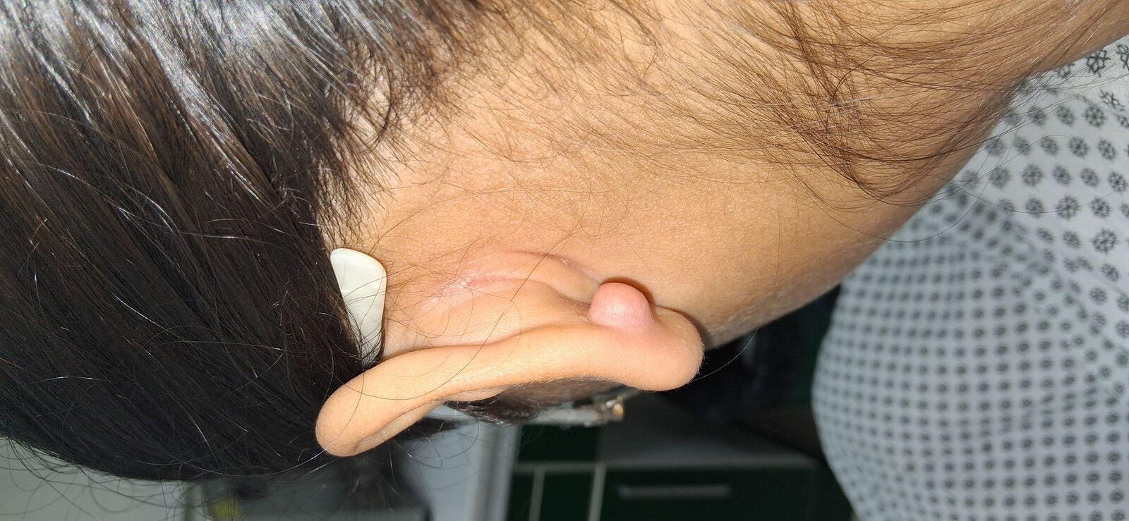Clinical case: Keloid