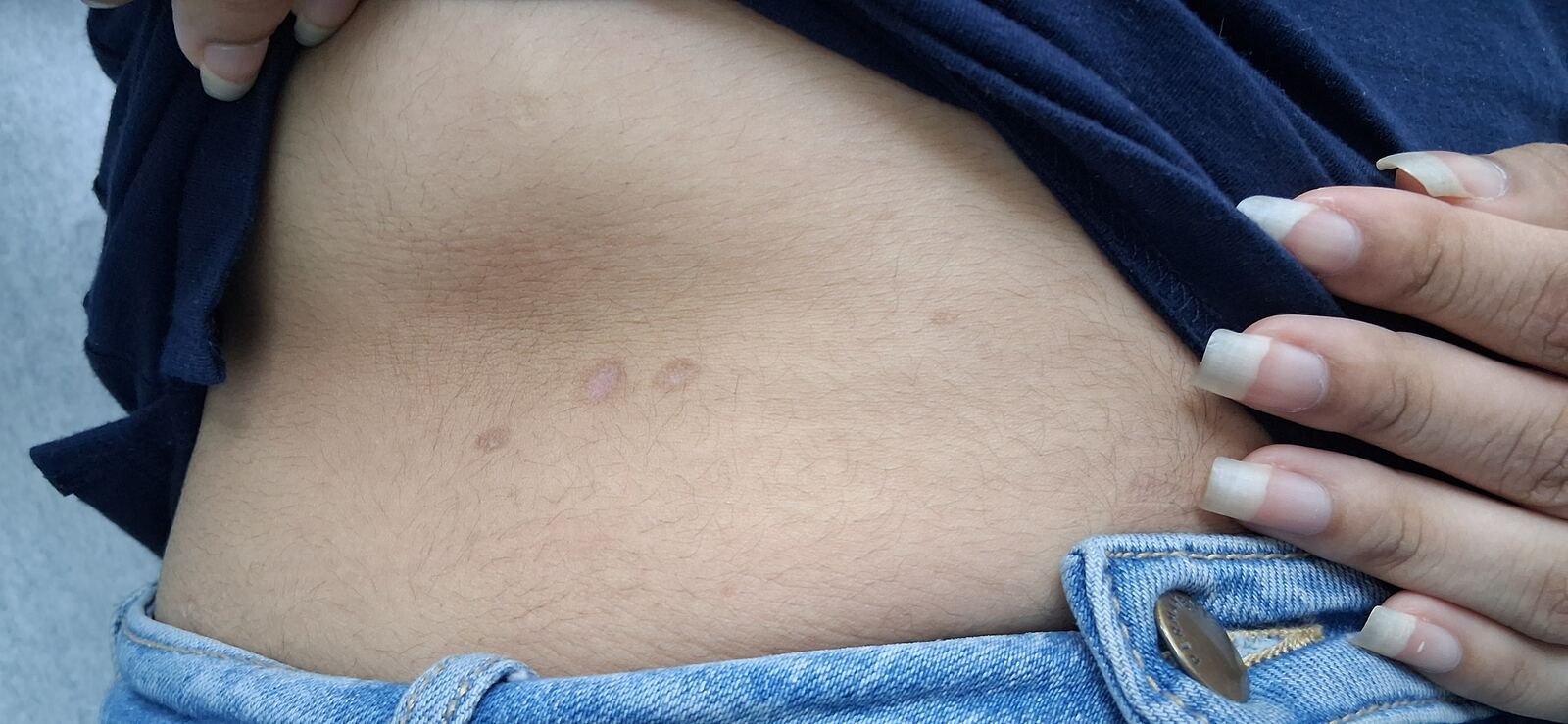 Clinical case: Burn