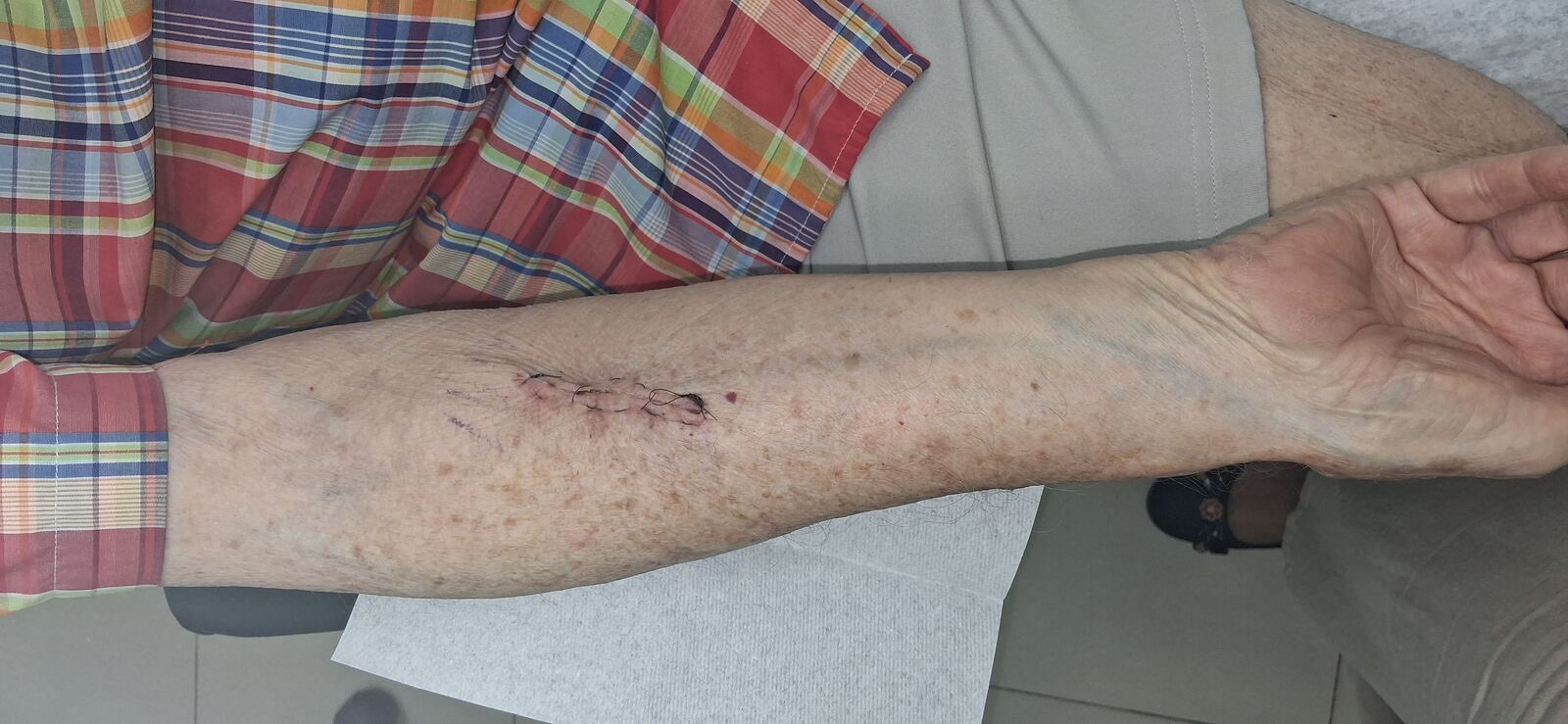 Keratoacanthoma: before image