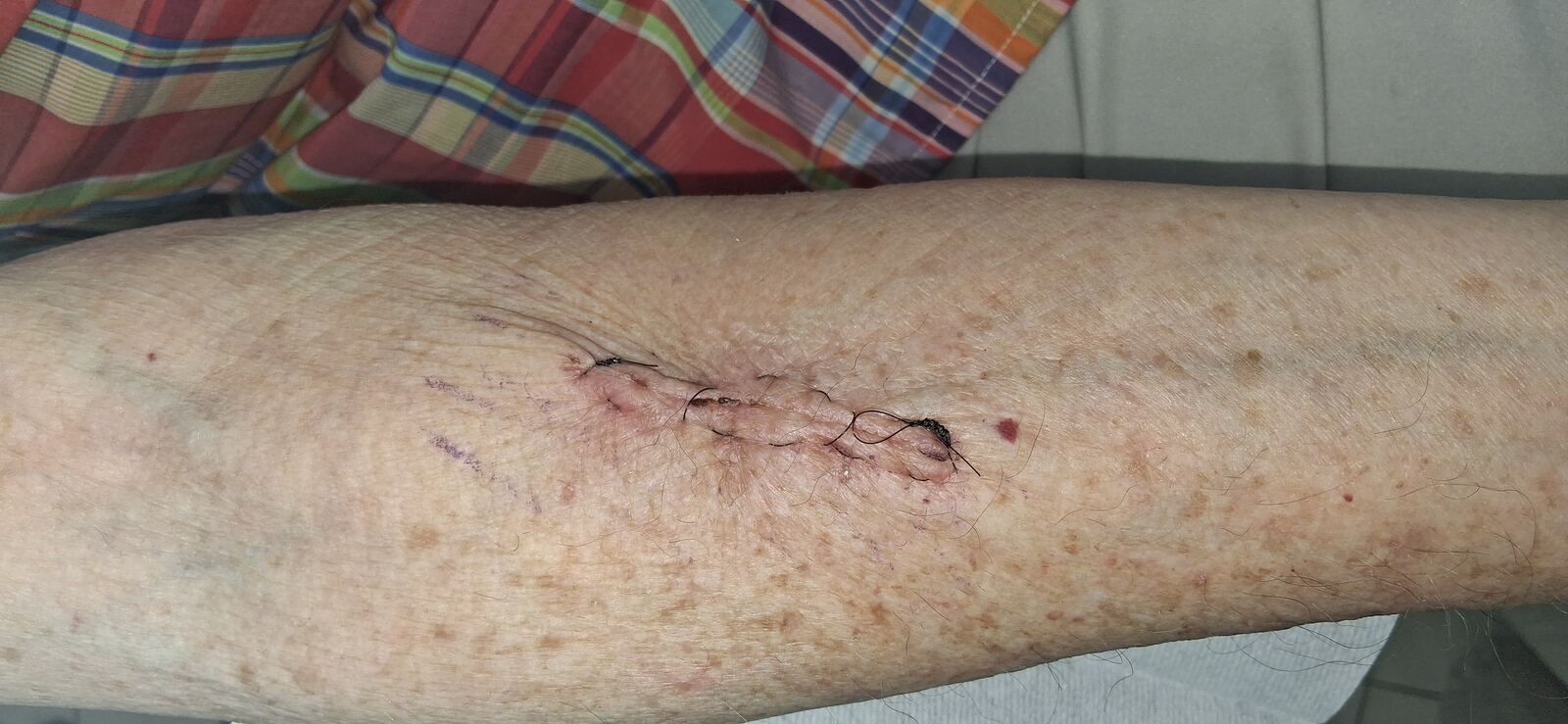 Keratoacanthoma: after image