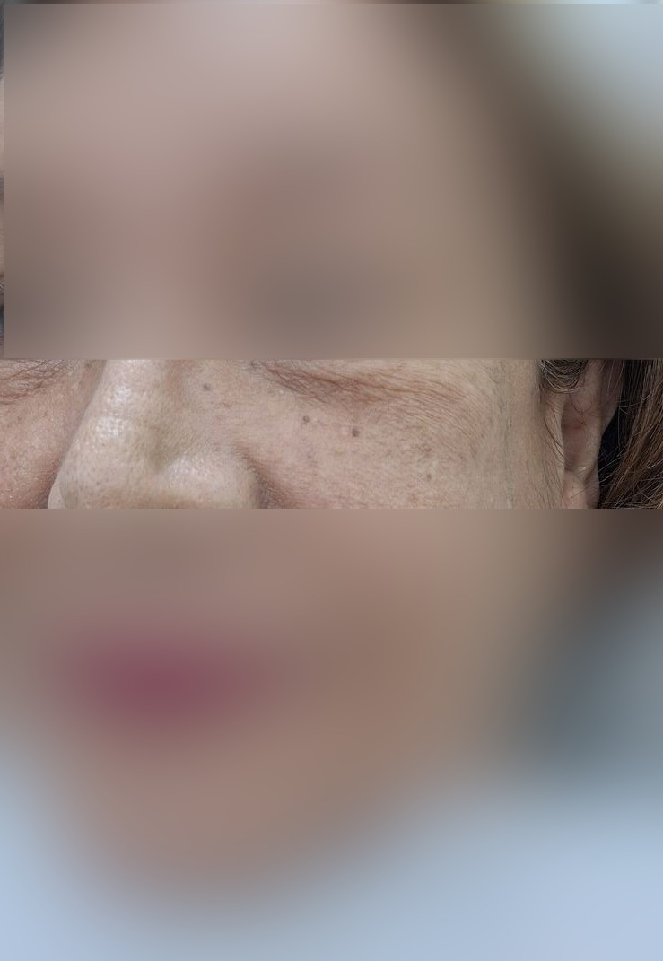 Actinic keratosis: before image