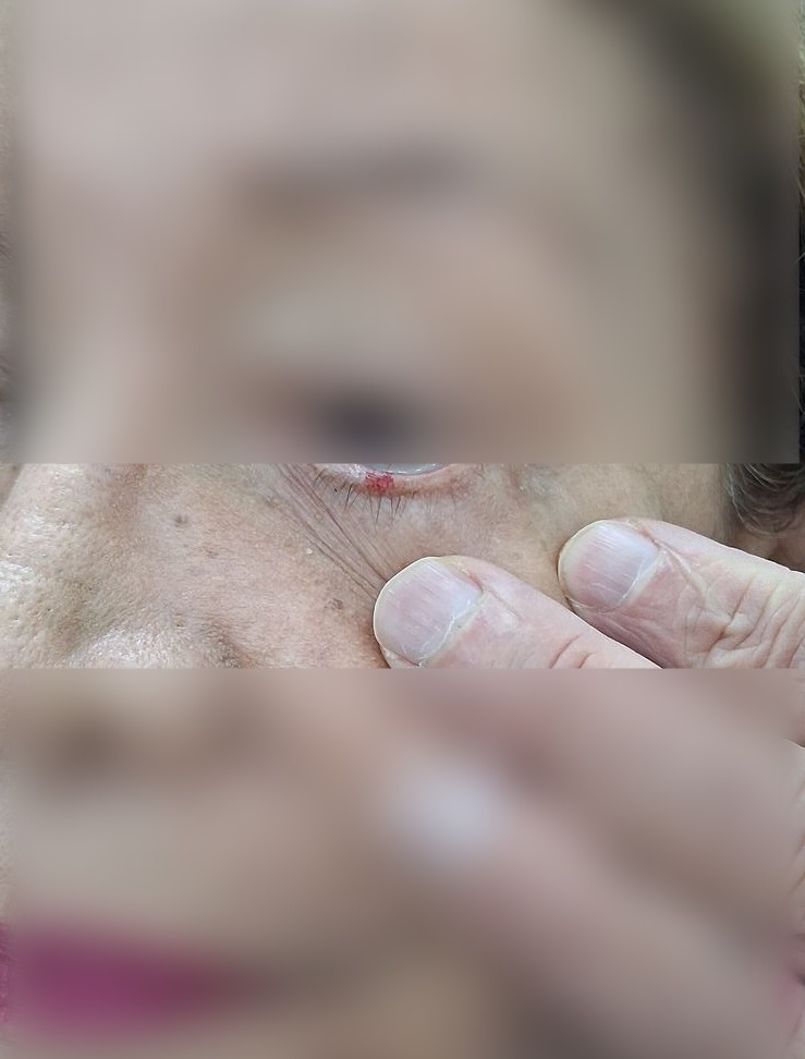 Actinic keratosis: after image