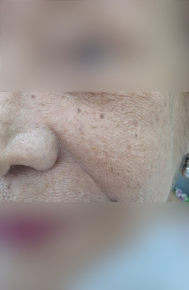 Clinical case: Actinic keratosis