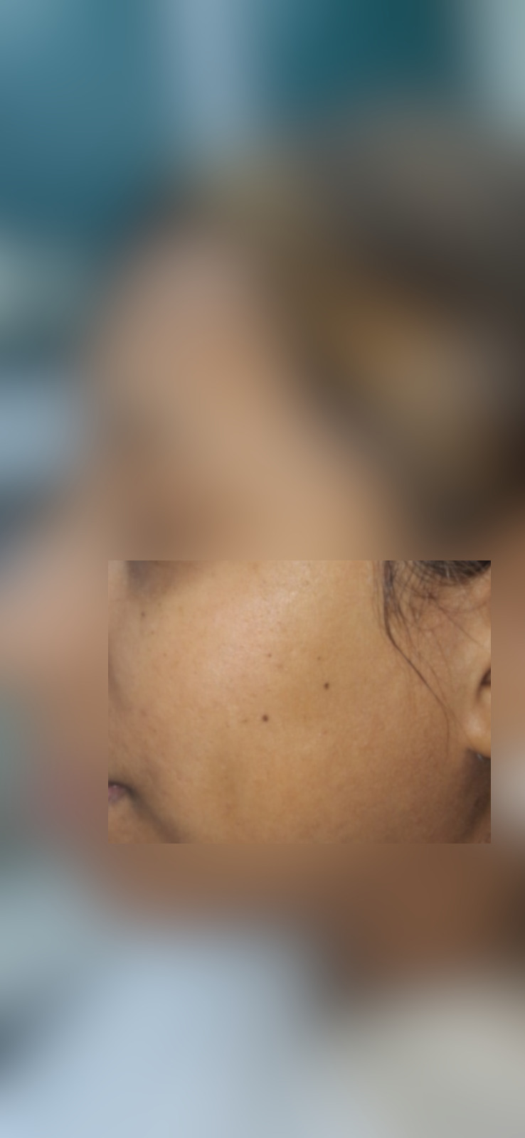 Seborrheic keratosis: before image