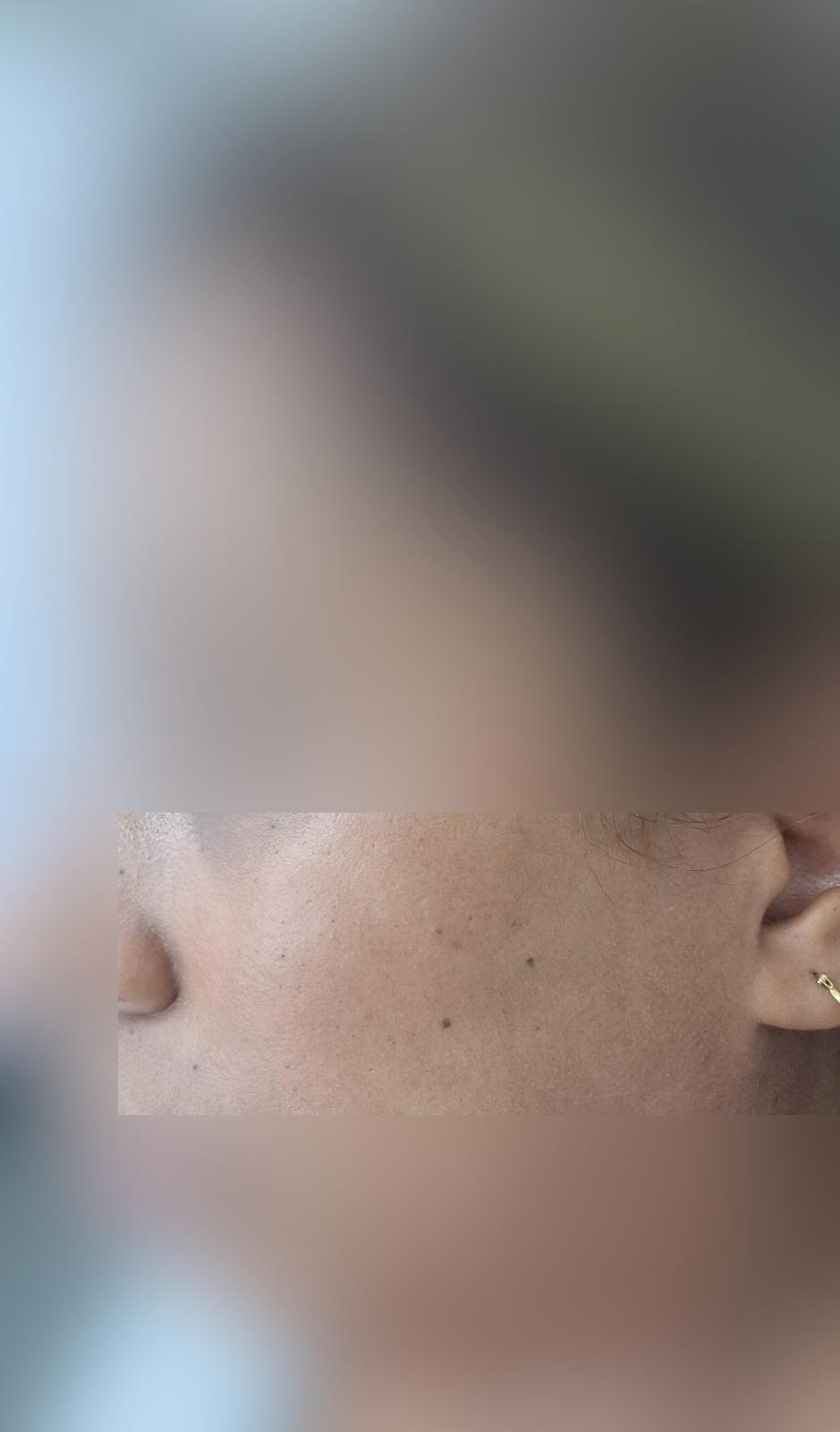 Seborrheic keratosis: after image