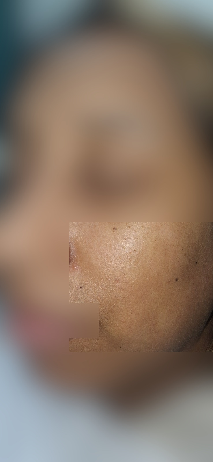 Clinical case: Seborrheic keratosis