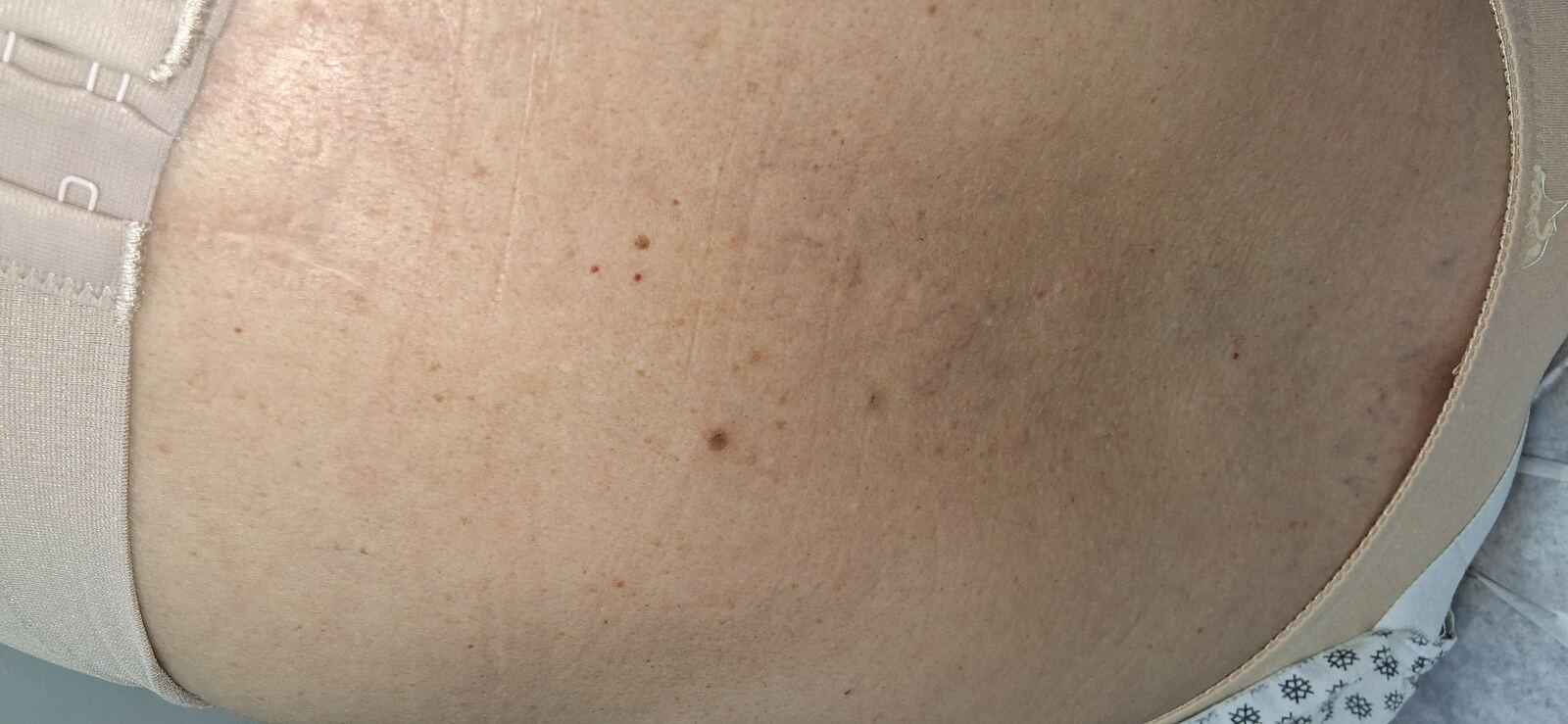 Inclusion cyst: before image