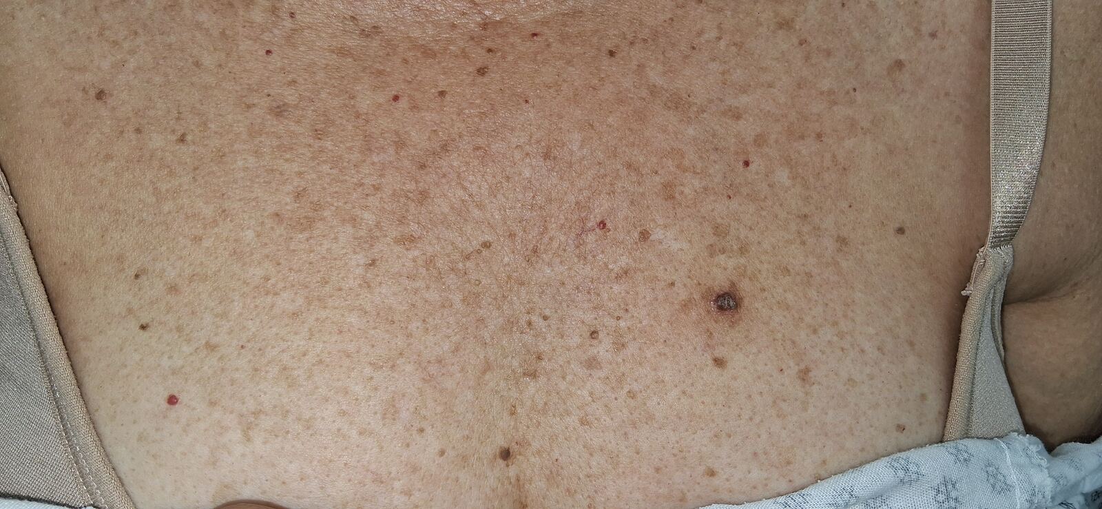 Clinical case: Inclusion cyst