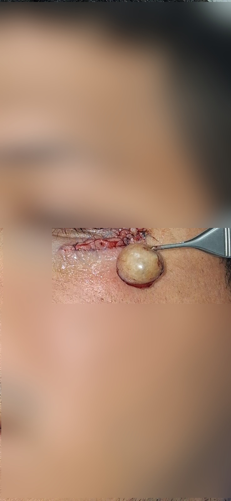 Epidermoid cyst: before image