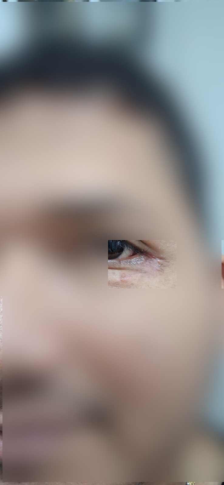 Epidermoid cyst: after image