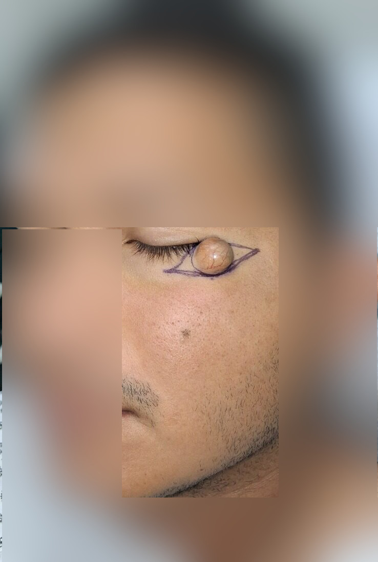Clinical case: Epidermoid cyst