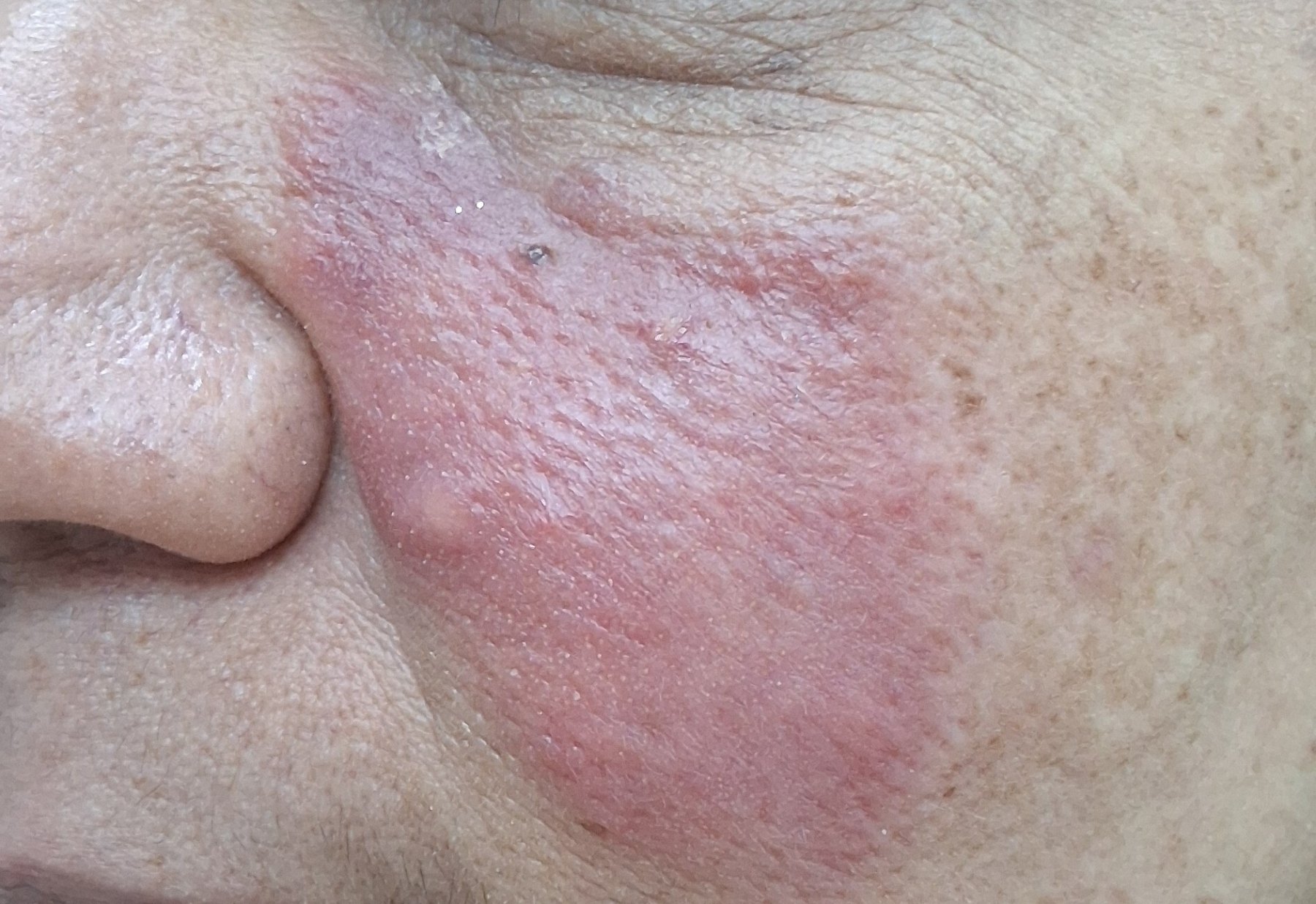 Erythematous rosacea: before image