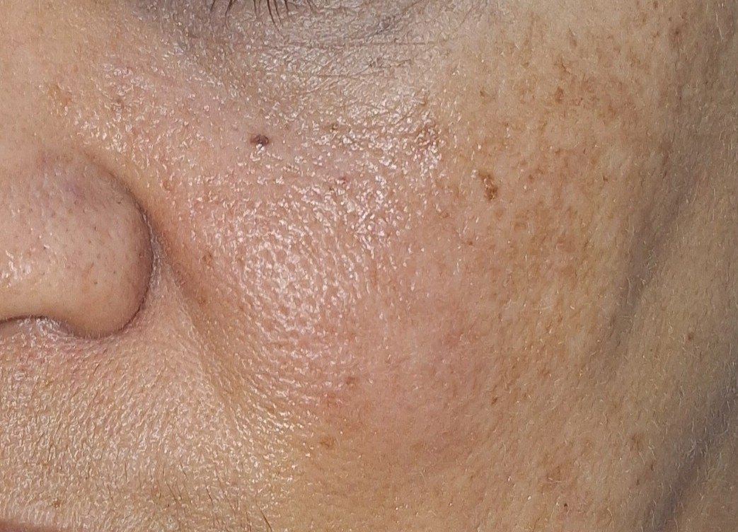 Erythematous rosacea: after image