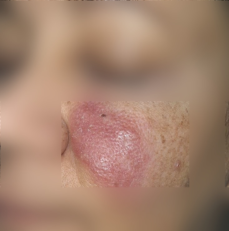 Clinical case: Erythematous rosacea