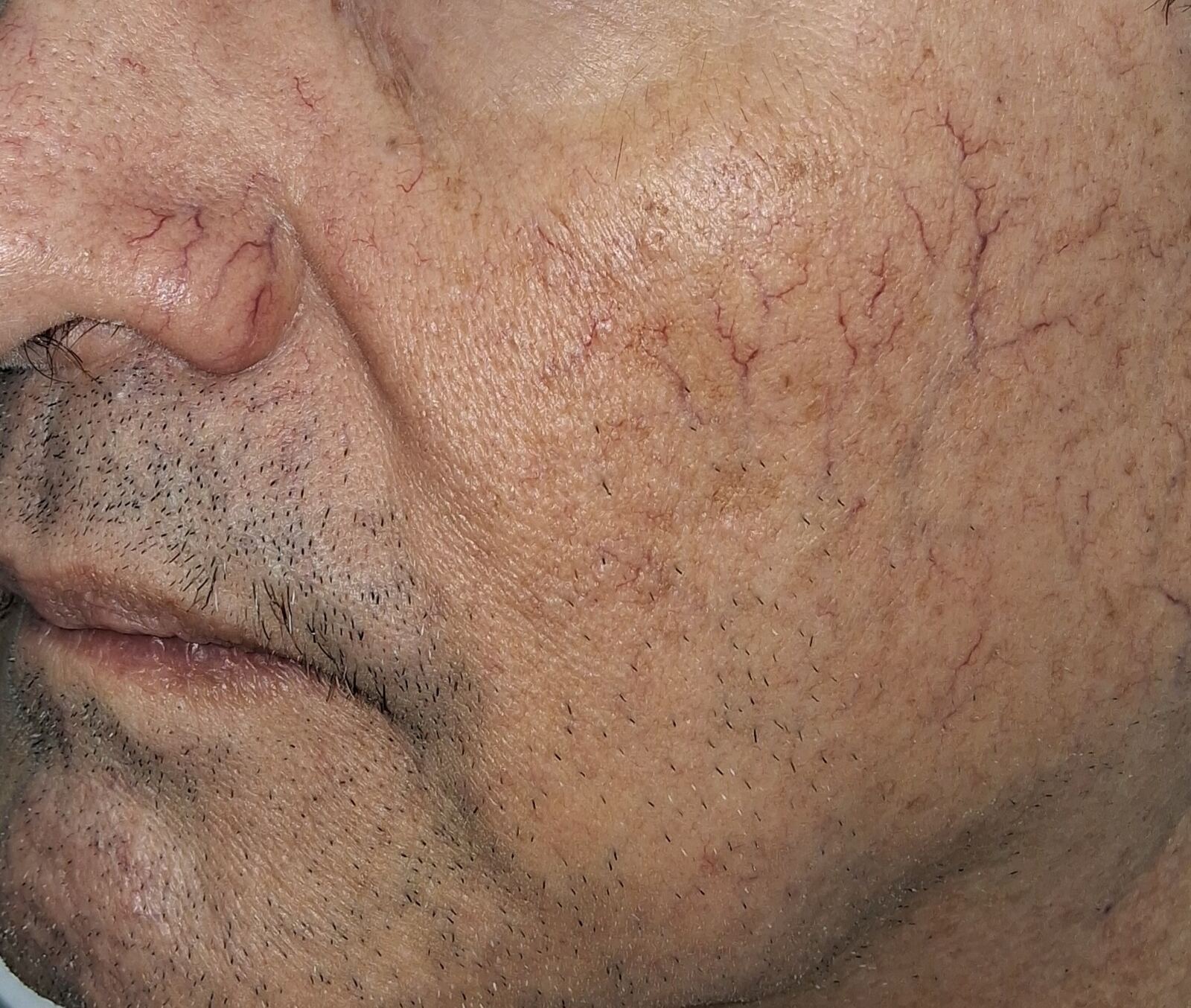 Telangiectatic rosacea and Demodex: before image