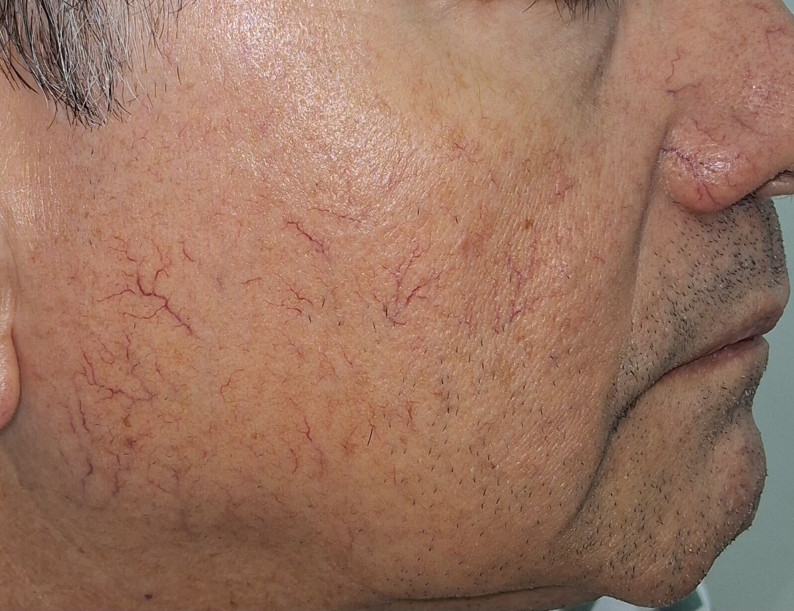 Telangiectatic rosacea and Demodex: after image