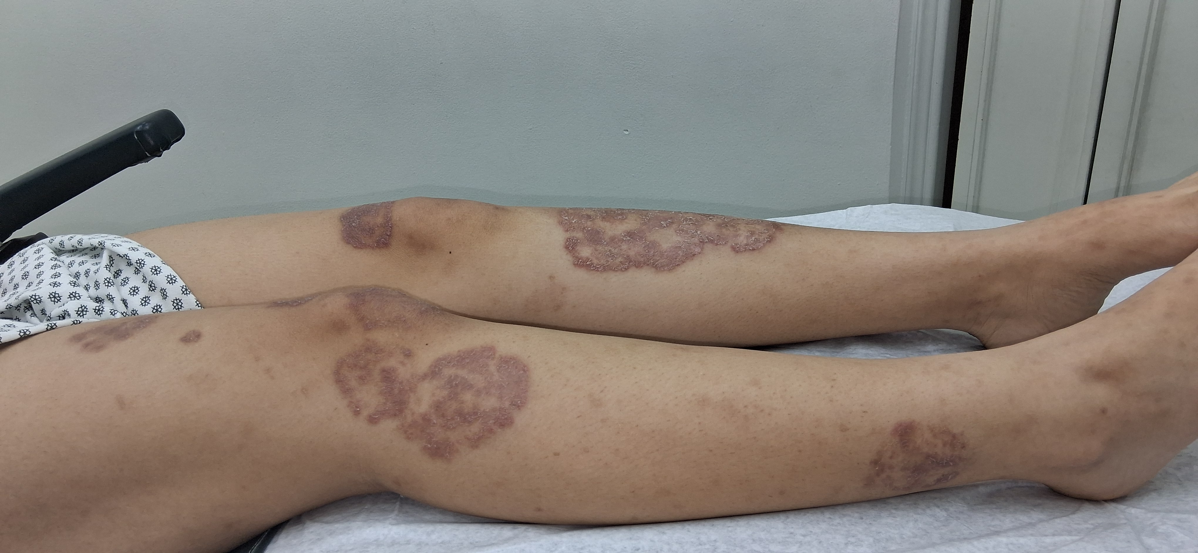 Tinea corporis: before image