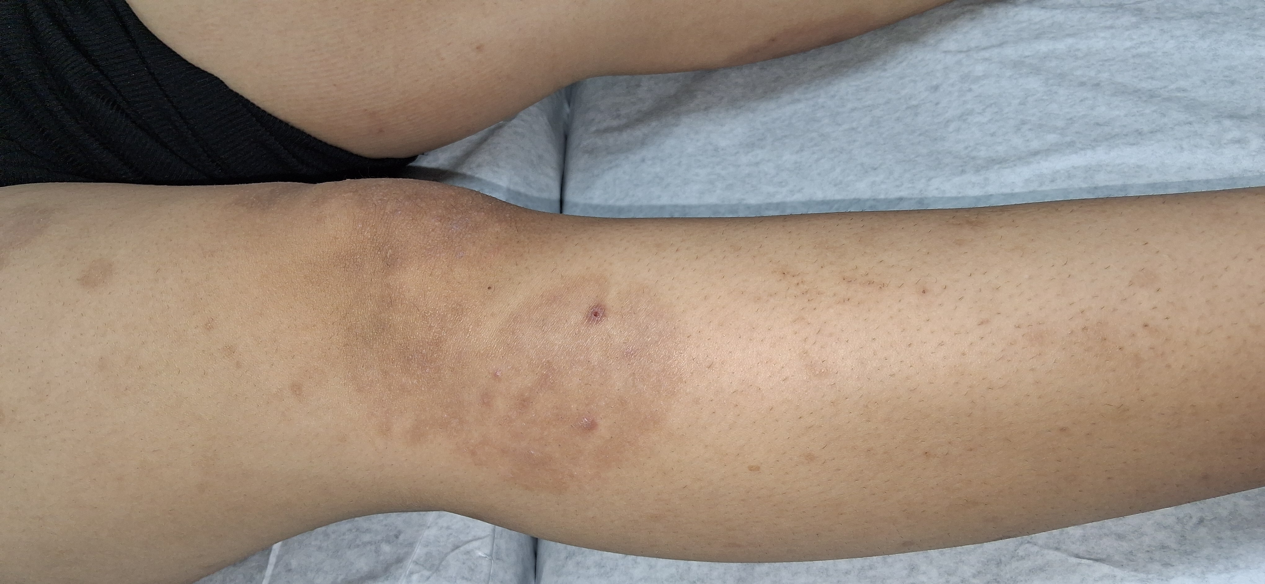 Tinea corporis: after image