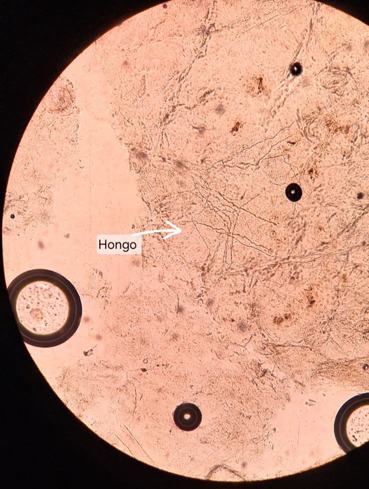 Clinical case of Tinea corporis