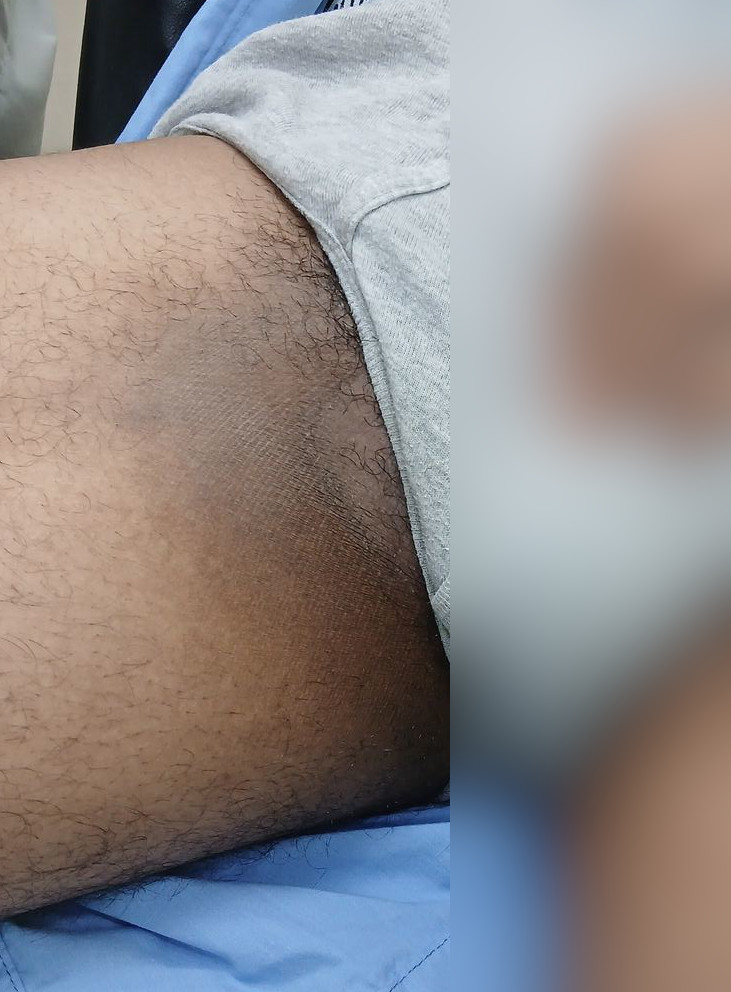 Tinea corporis: after image