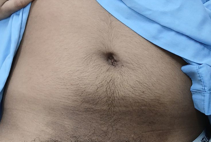 Tinea cruris: before image