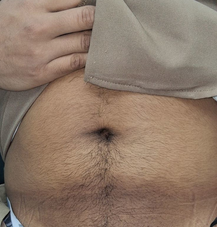 Tinea cruris: after image