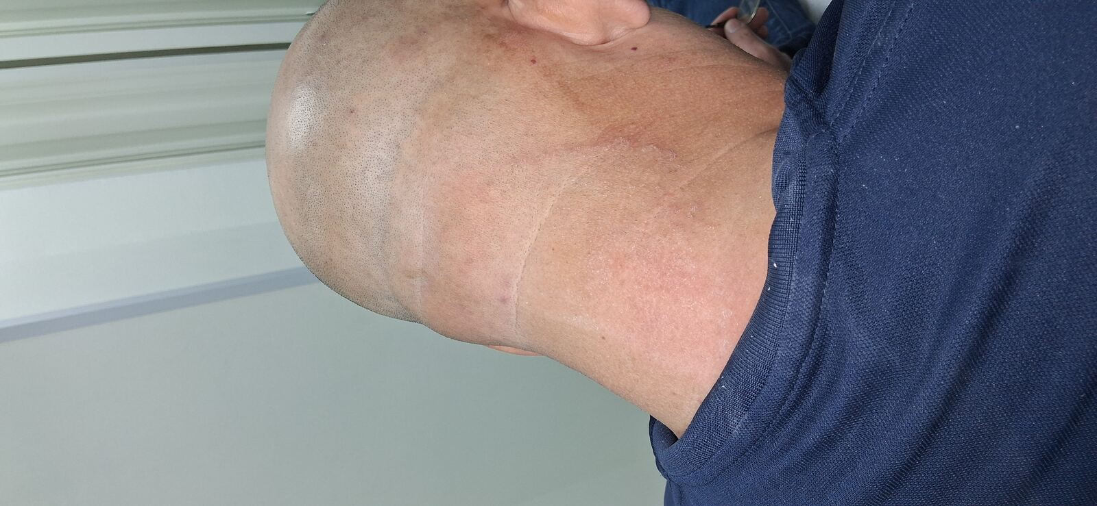 Tinea incognito: before image