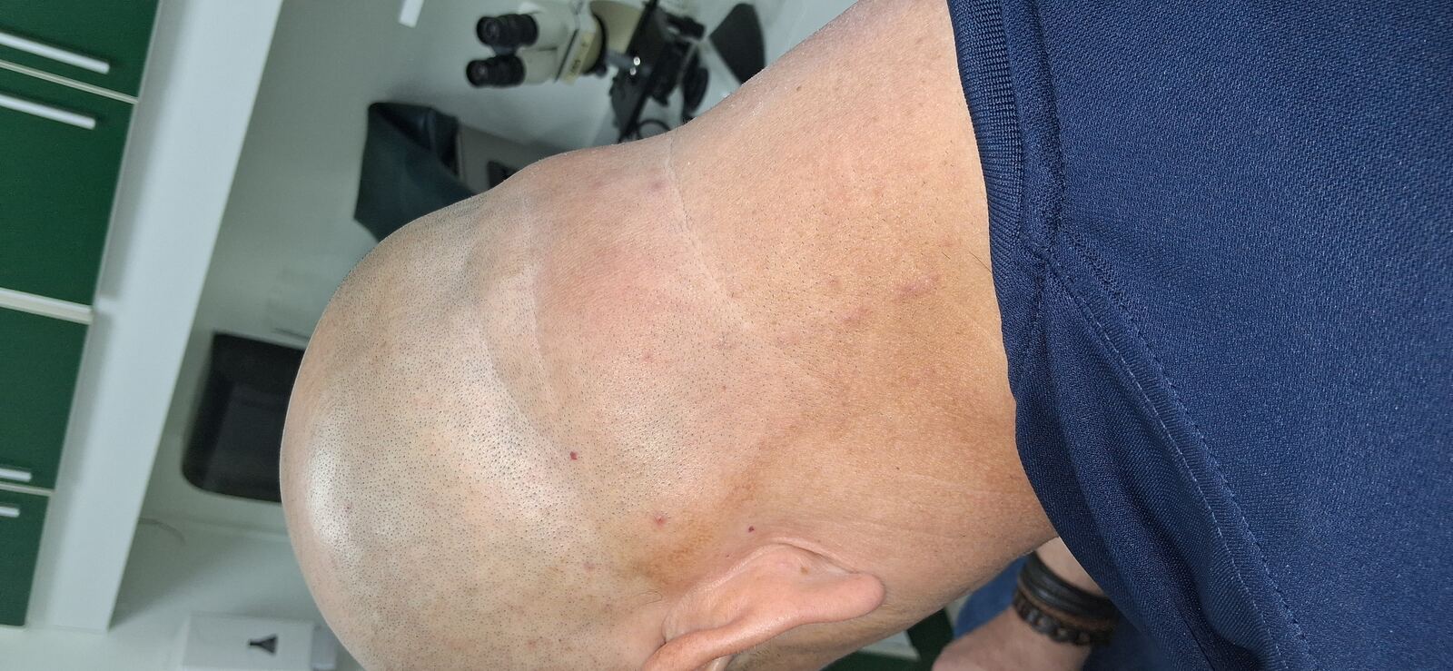 Tinea incognito: after image