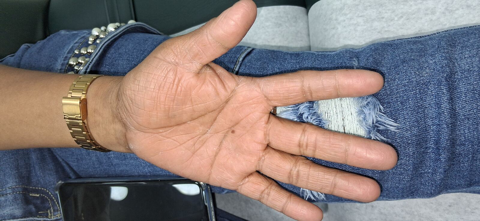 Tinea manuum: before image