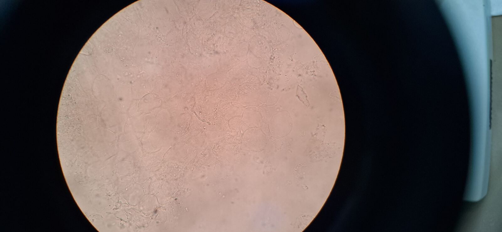 Tinea manuum: after image