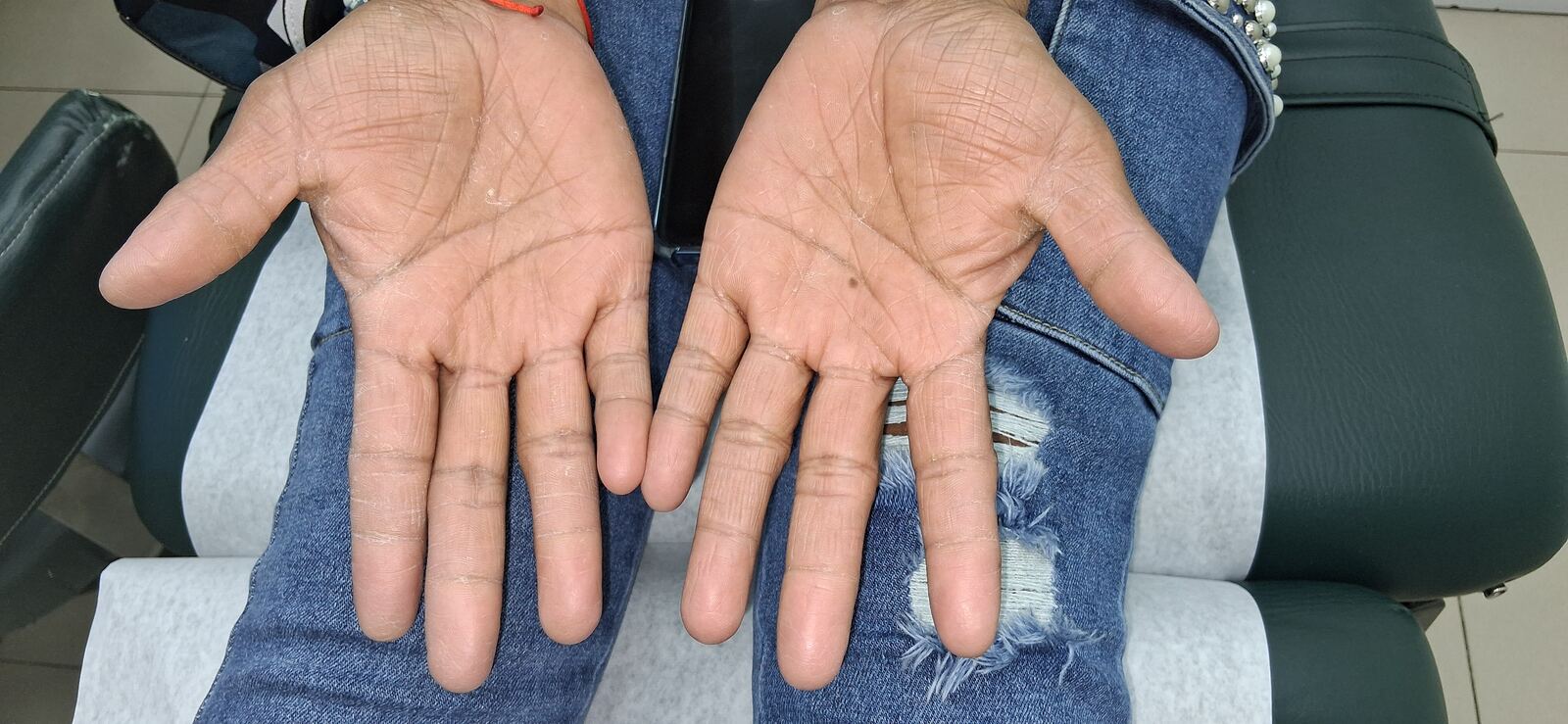Clinical case: Tinea manuum