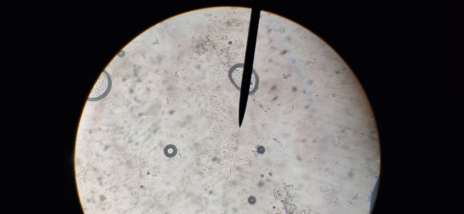 Tinea nigra: before image